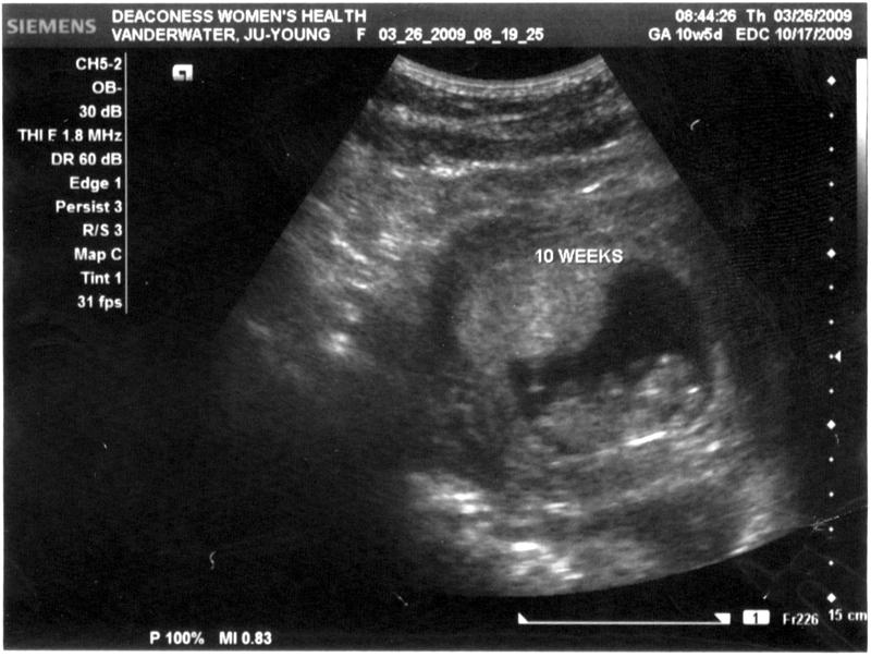 10 Week ultrasound