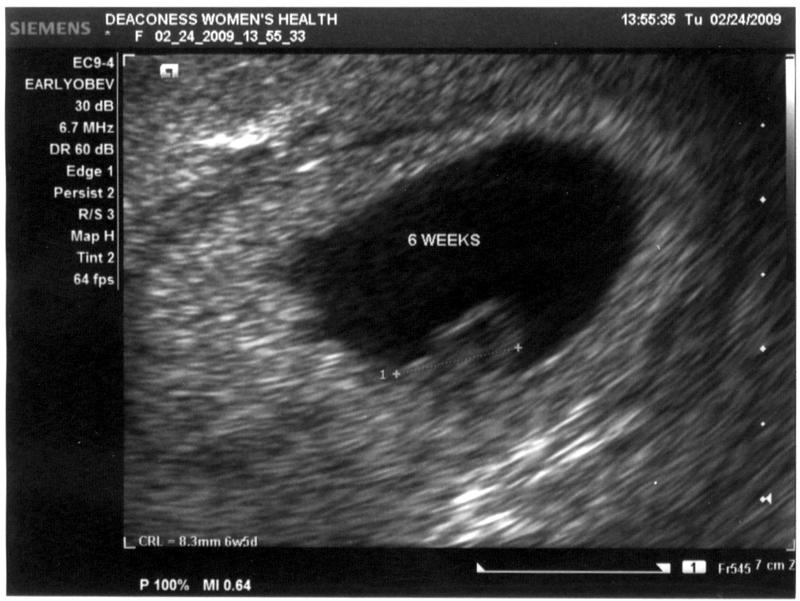 6 week ultrasound